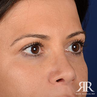 Eyelid Surgery Before & After Gallery - Patient 163128 - Image 4