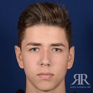 Ear Pinning Surgery Before & After Gallery - Patient 237783 - Image 2