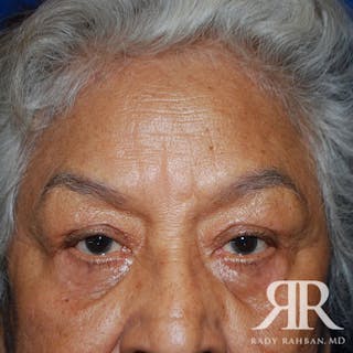 Browlift Before & After Gallery - Patient 876005 - Image 4