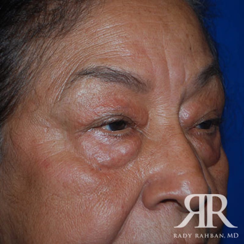 Browlift Before & After Gallery - Patient 876005 - Image 5