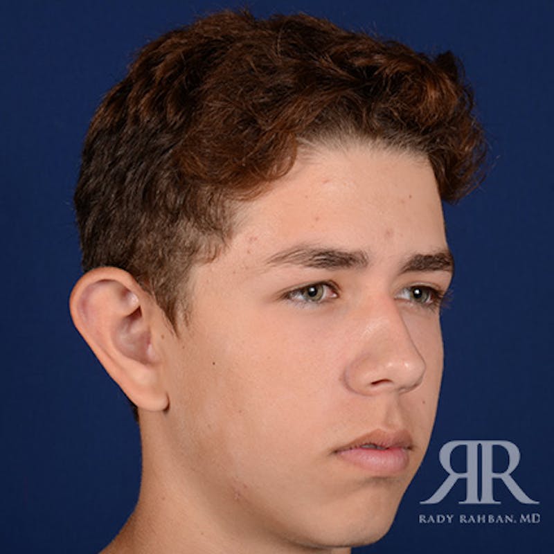 Ear Pinning Surgery Before & After Gallery - Patient 237783 - Image 3