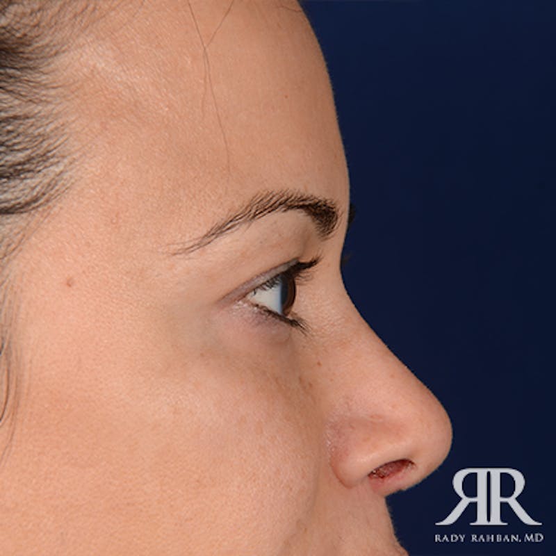 Eyelid Surgery Before & After Gallery - Patient 163128 - Image 5