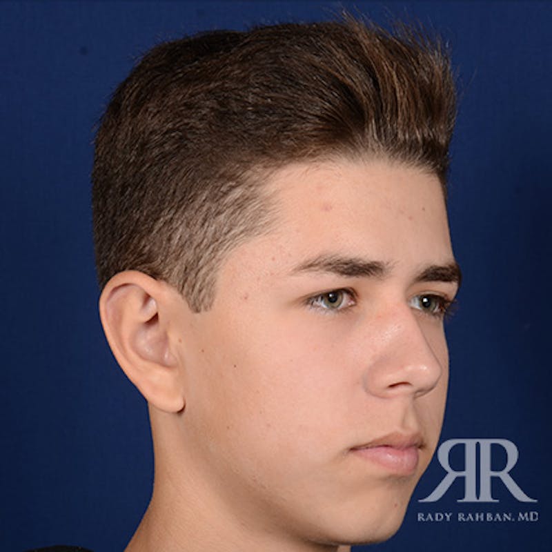 Ear Pinning Surgery Before & After Gallery - Patient 237783 - Image 4