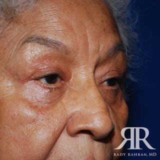 Browlift Before & After Gallery - Patient 876005 - Image 6