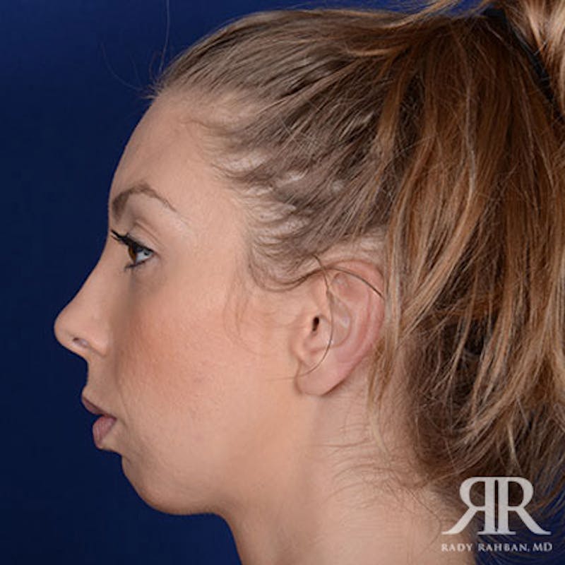 Chin Augmentation Before & After Gallery - Patient 361365 - Image 5