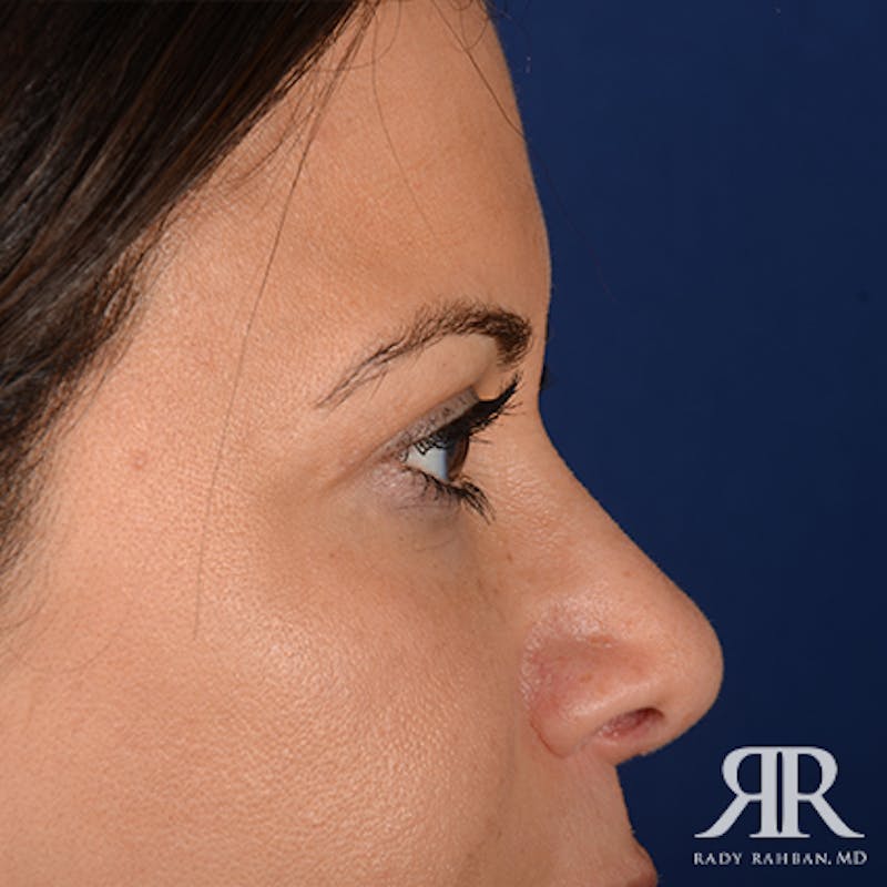 Eyelid Surgery Before & After Gallery - Patient 163128 - Image 6
