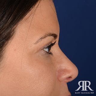 Eyelid Surgery Before & After Gallery - Patient 163128 - Image 6