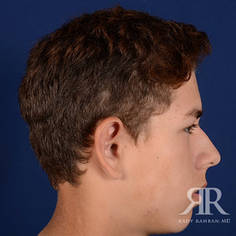 Ear Pinning Surgery Before & After Gallery - Patient 237783 - Image 5