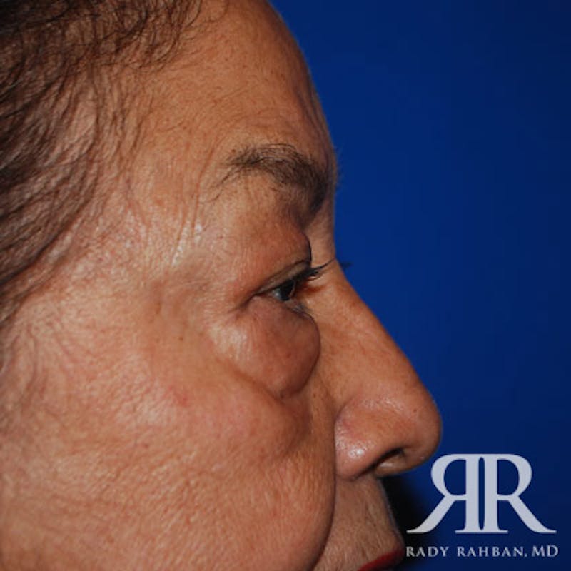 Browlift Before & After Gallery - Patient 876005 - Image 7