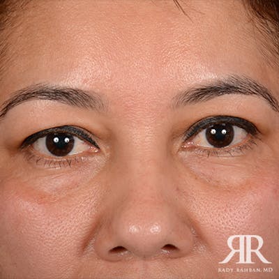 Eyelid Surgery Before & After Gallery - Patient 974644 - Image 1