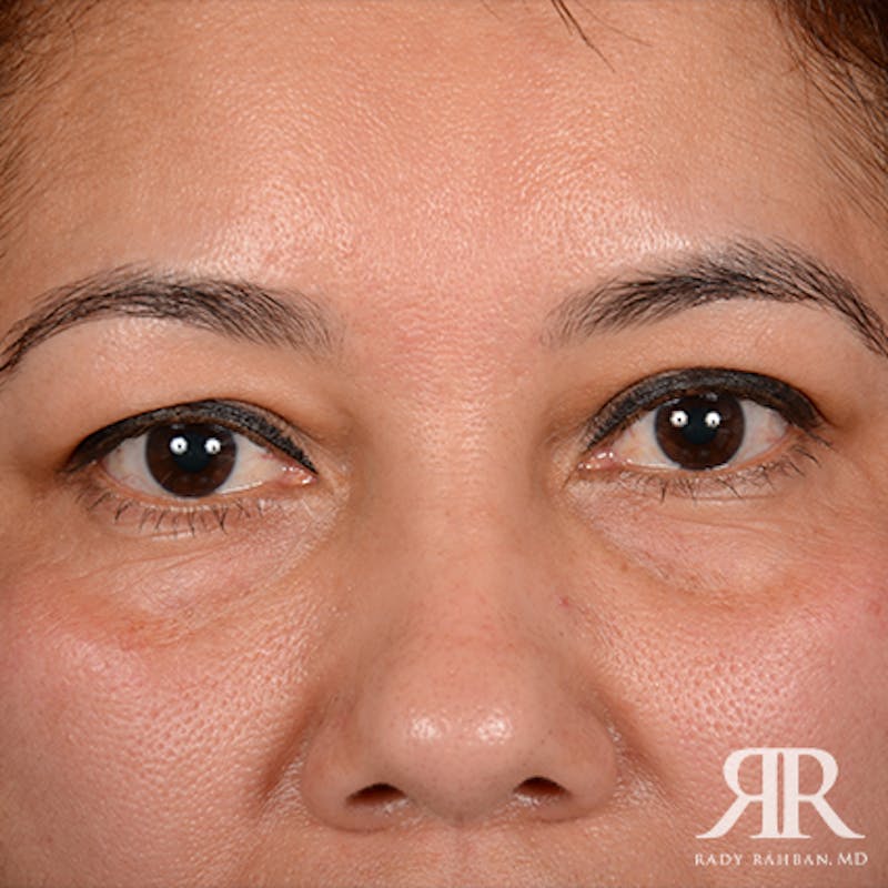 Eyelid Surgery Before & After Gallery - Patient 974644 - Image 1