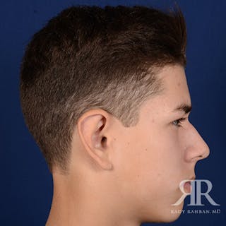 Ear Pinning Surgery Before & After Gallery - Patient 237783 - Image 6