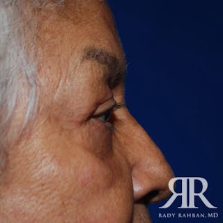 Browlift Before & After Gallery - Patient 876005 - Image 8