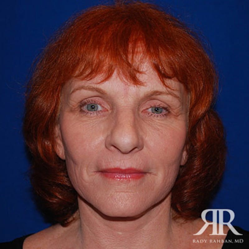 Before and after patient results