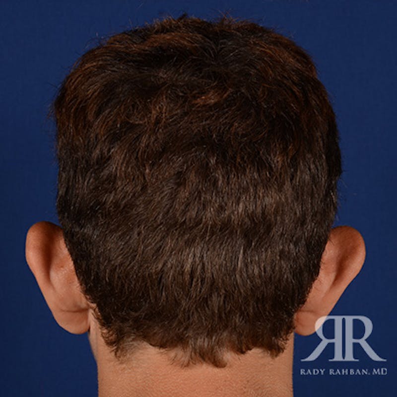 Ear Pinning Surgery Before & After Gallery - Patient 237783 - Image 7