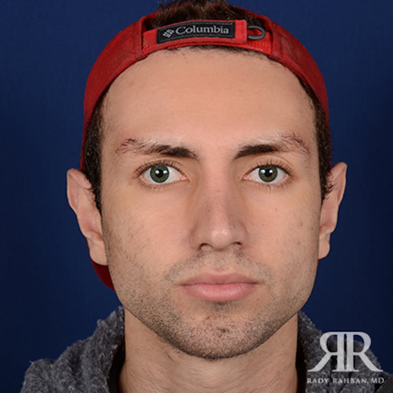 Before and after patient results
