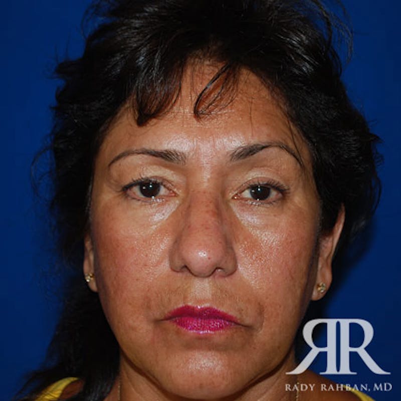 Browlift Before & After Gallery - Patient 356691 - Image 1