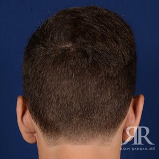 Ear Pinning Surgery Before & After Gallery - Patient 237783 - Image 8