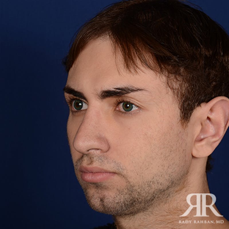 Chin Augmentation Before & After Gallery - Patient 264469 - Image 3