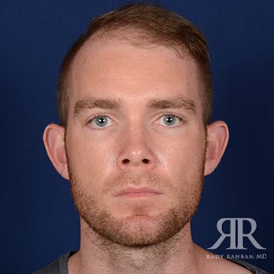 Ear Pinning Surgery Before & After Gallery - Patient 264744 - Image 1