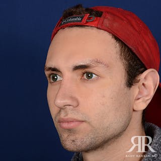 Chin Augmentation Before & After Gallery - Patient 264469 - Image 4