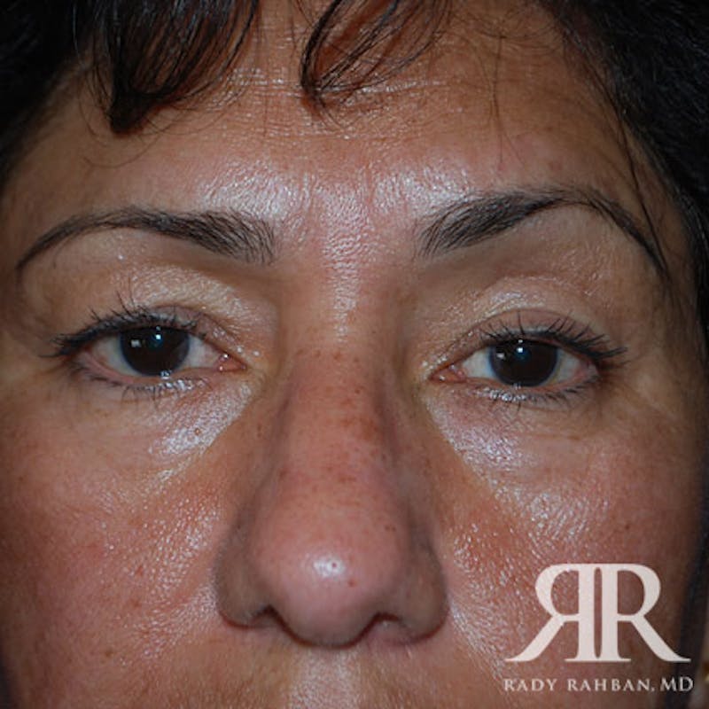 Browlift Before & After Gallery - Patient 356691 - Image 3