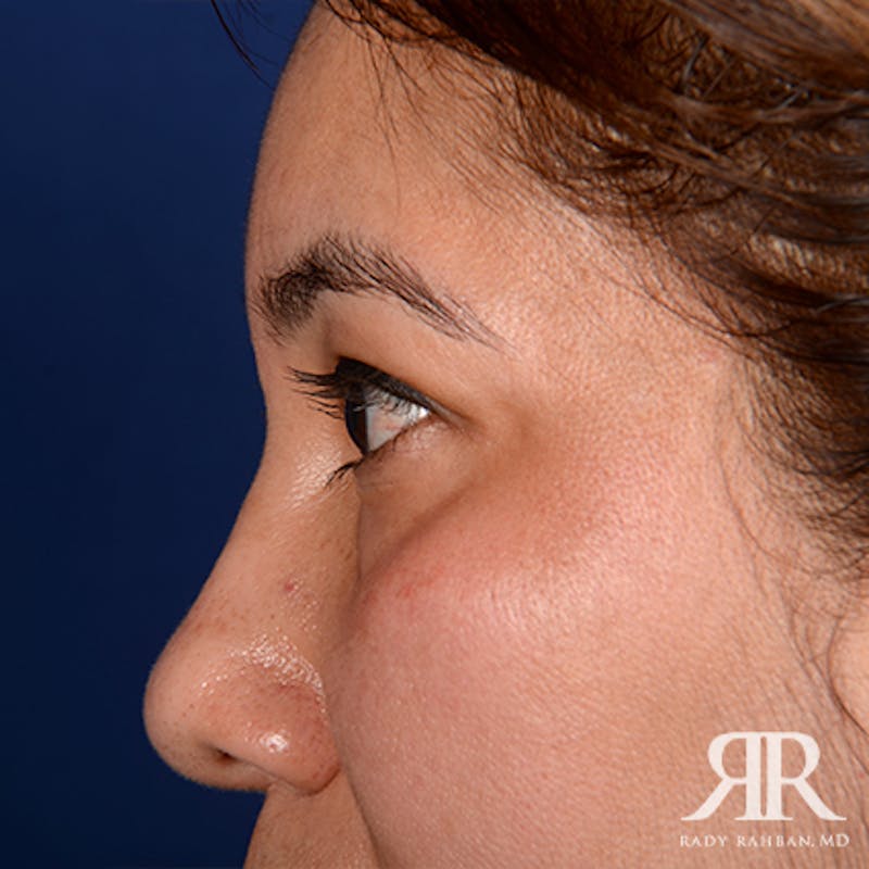 Eyelid Surgery Before & After Gallery - Patient 974644 - Image 5