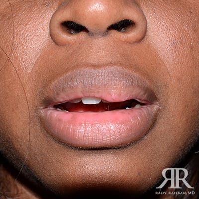 Lip Reduction / Lip Correction Before & After Gallery - Patient 492974 - Image 1