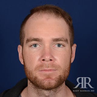 Ear Pinning Surgery Before & After Gallery - Patient 264744 - Image 2