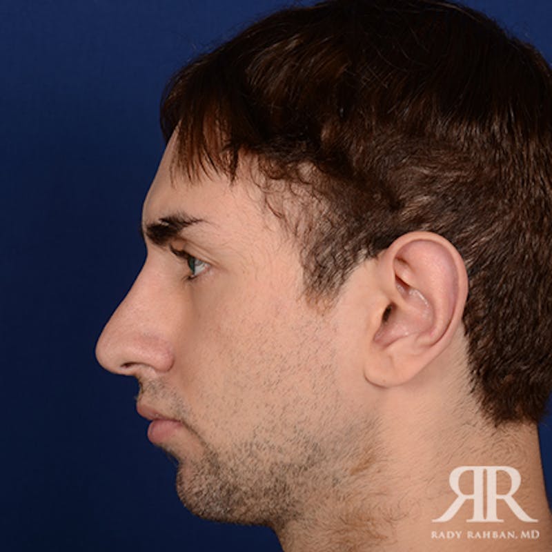 Chin Augmentation Before & After Gallery - Patient 264469 - Image 5