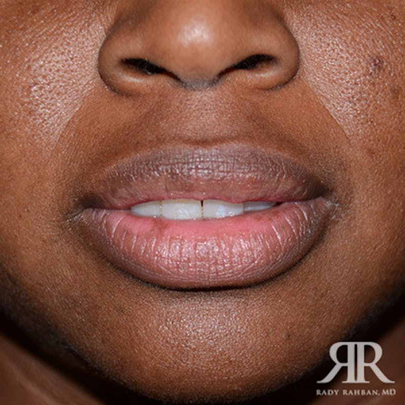 Before and after patient results