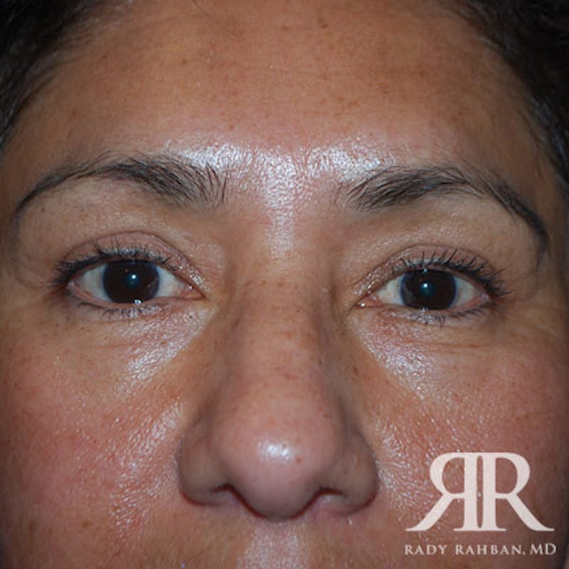 Browlift Before & After Gallery - Patient 356691 - Image 4