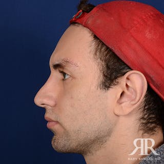 Chin Augmentation Before & After Gallery - Patient 264469 - Image 6