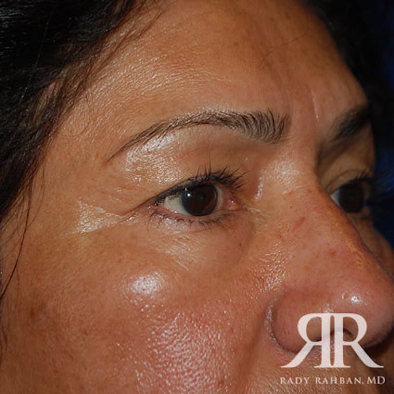 Browlift Before & After Gallery - Patient 356691 - Image 5