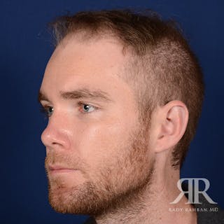 Ear Pinning Surgery Before & After Gallery - Patient 264744 - Image 4