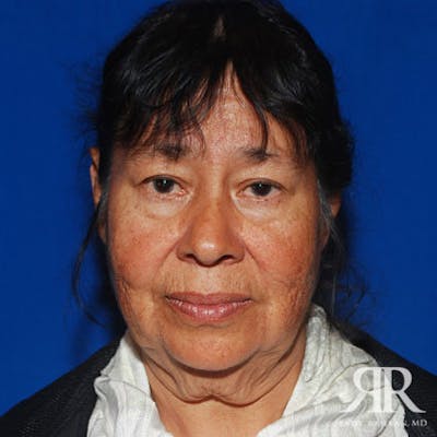 Facelift Before & After Gallery - Patient 424377 - Image 1