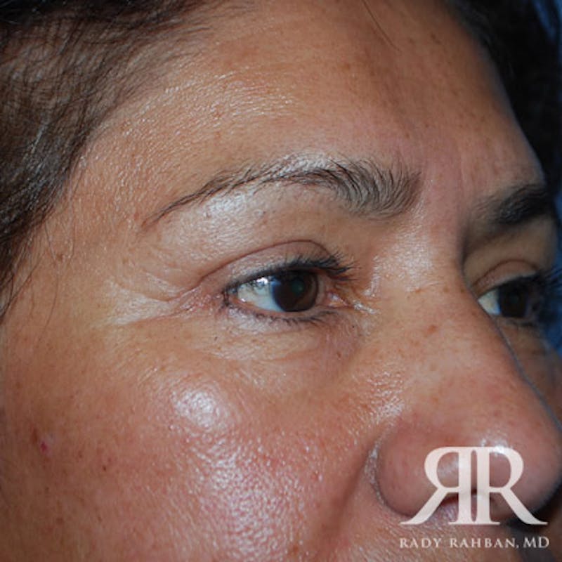 Browlift Before & After Gallery - Patient 356691 - Image 6