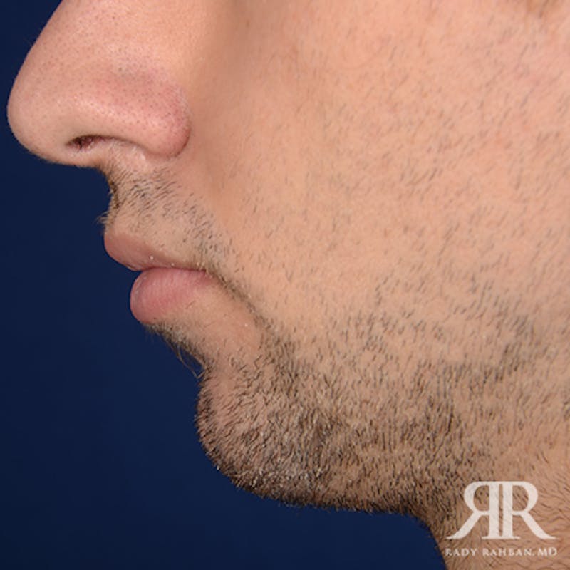 Chin Augmentation Before & After Gallery - Patient 264469 - Image 7