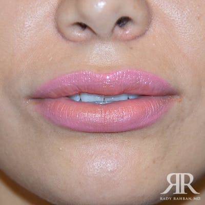 Lip Reduction / Lip Correction Before & After Gallery - Patient 149308 - Image 2