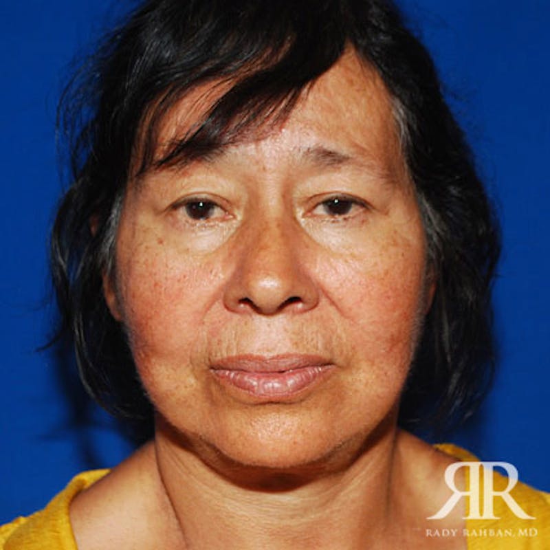 Before and after patient results
