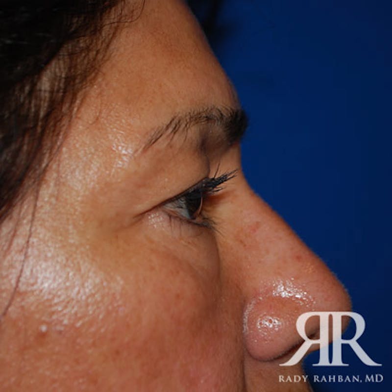 Browlift Before & After Gallery - Patient 356691 - Image 7