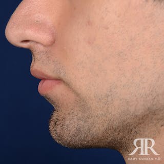 Chin Augmentation Before & After Gallery - Patient 264469 - Image 8