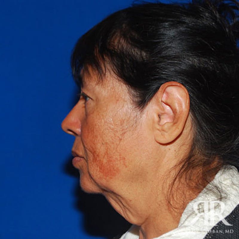 Facelift Before & After Gallery - Patient 424377 - Image 3