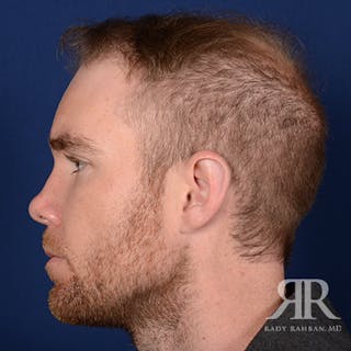 Ear Pinning Surgery Before & After Gallery - Patient 264744 - Image 6