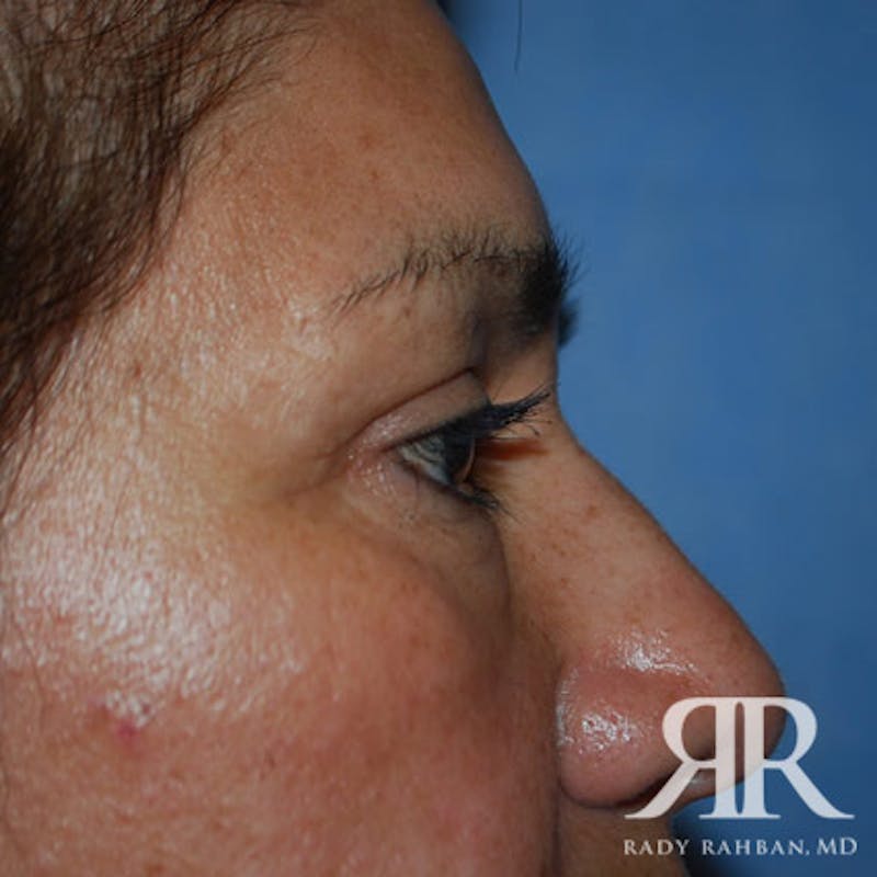Browlift Before & After Gallery - Patient 356691 - Image 8