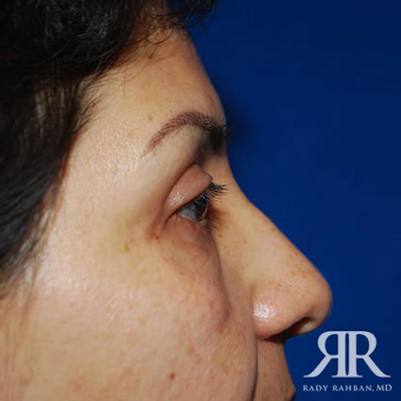 Eyelid Surgery Before & After Gallery - Patient 203299 - Image 4