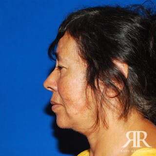 Facelift Before & After Gallery - Patient 424377 - Image 4