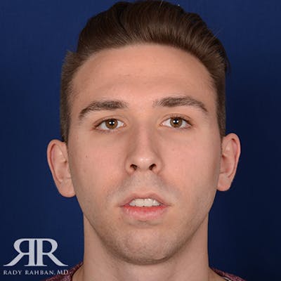 Chin Augmentation Before & After Gallery - Patient 361159 - Image 1