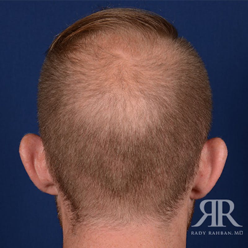 Ear Pinning Surgery Before & After Gallery - Patient 264744 - Image 7
