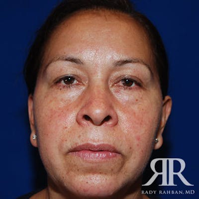 Browlift Before & After Gallery - Patient 296243 - Image 1